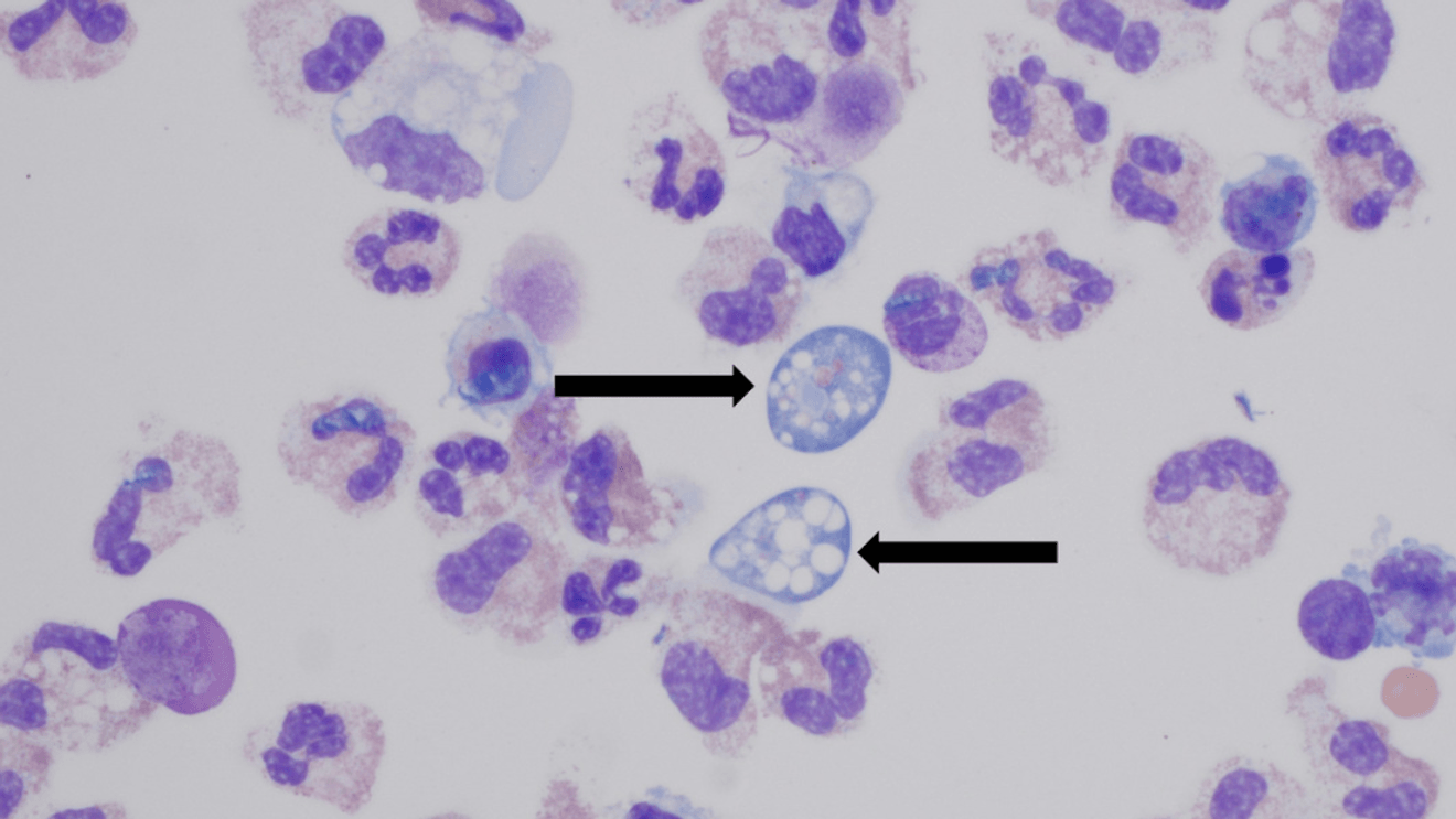 brain-eating-amoeba-infection-in-durham-why-it-ma-6aaab6a42acdd