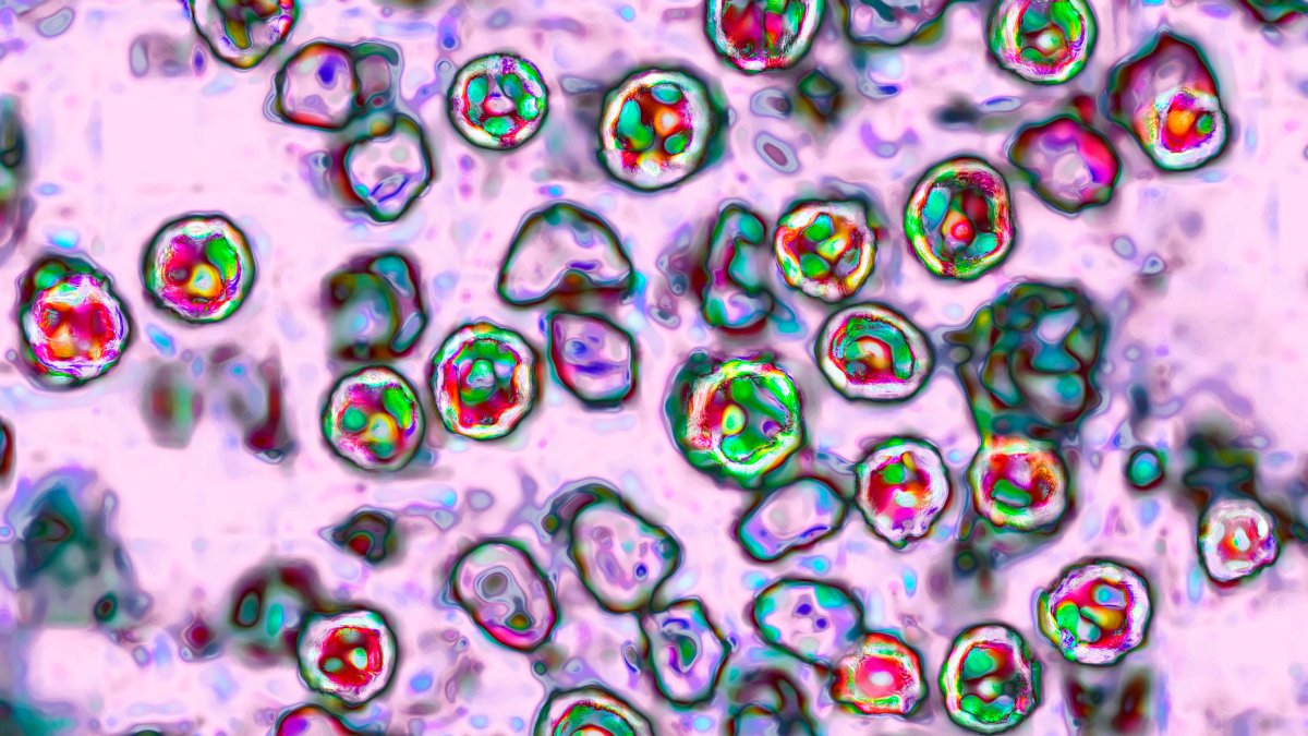 philadelphia-measles-exposure-what-travelers-need-6aafa804bf527