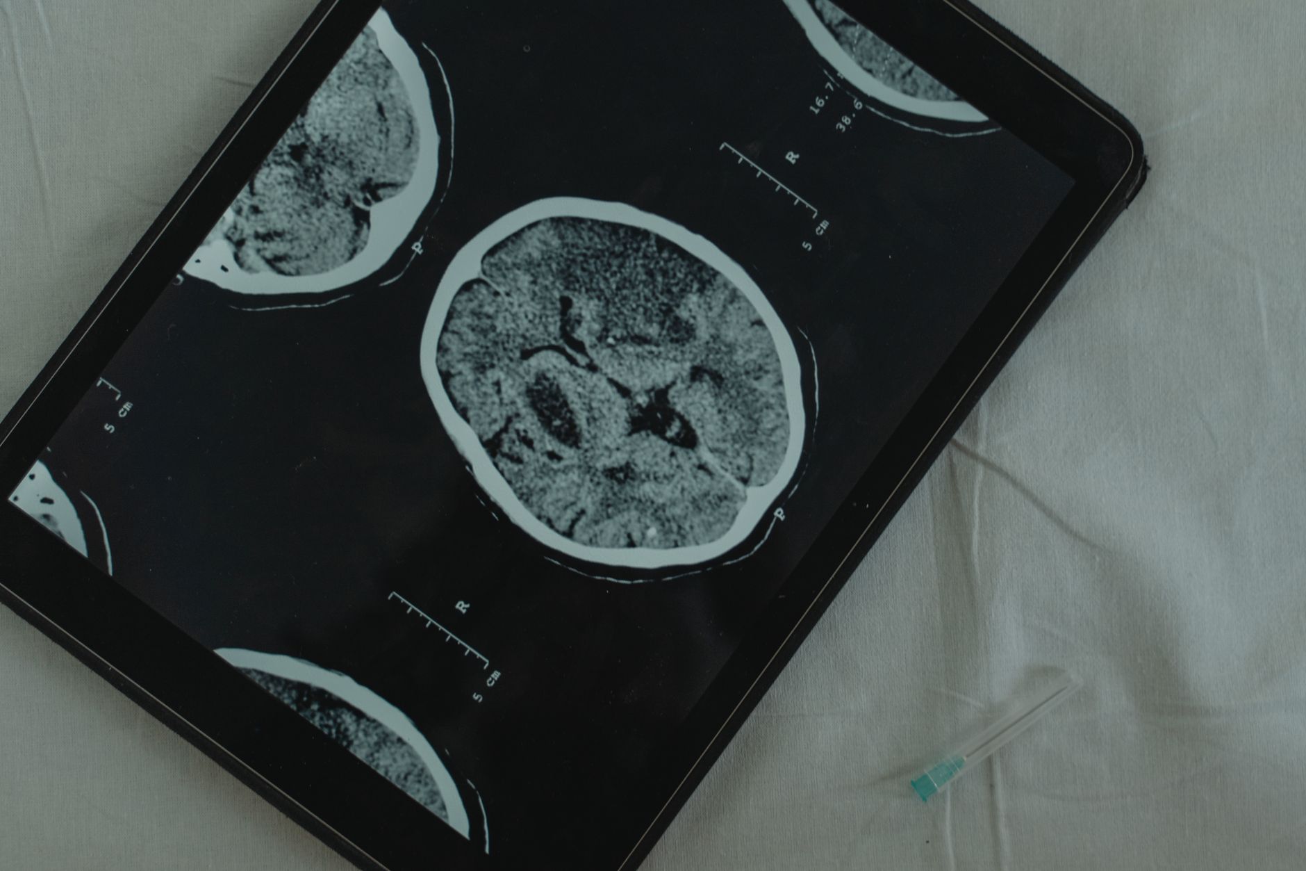 Close-up view of a brain CT scan displayed on a digital tablet