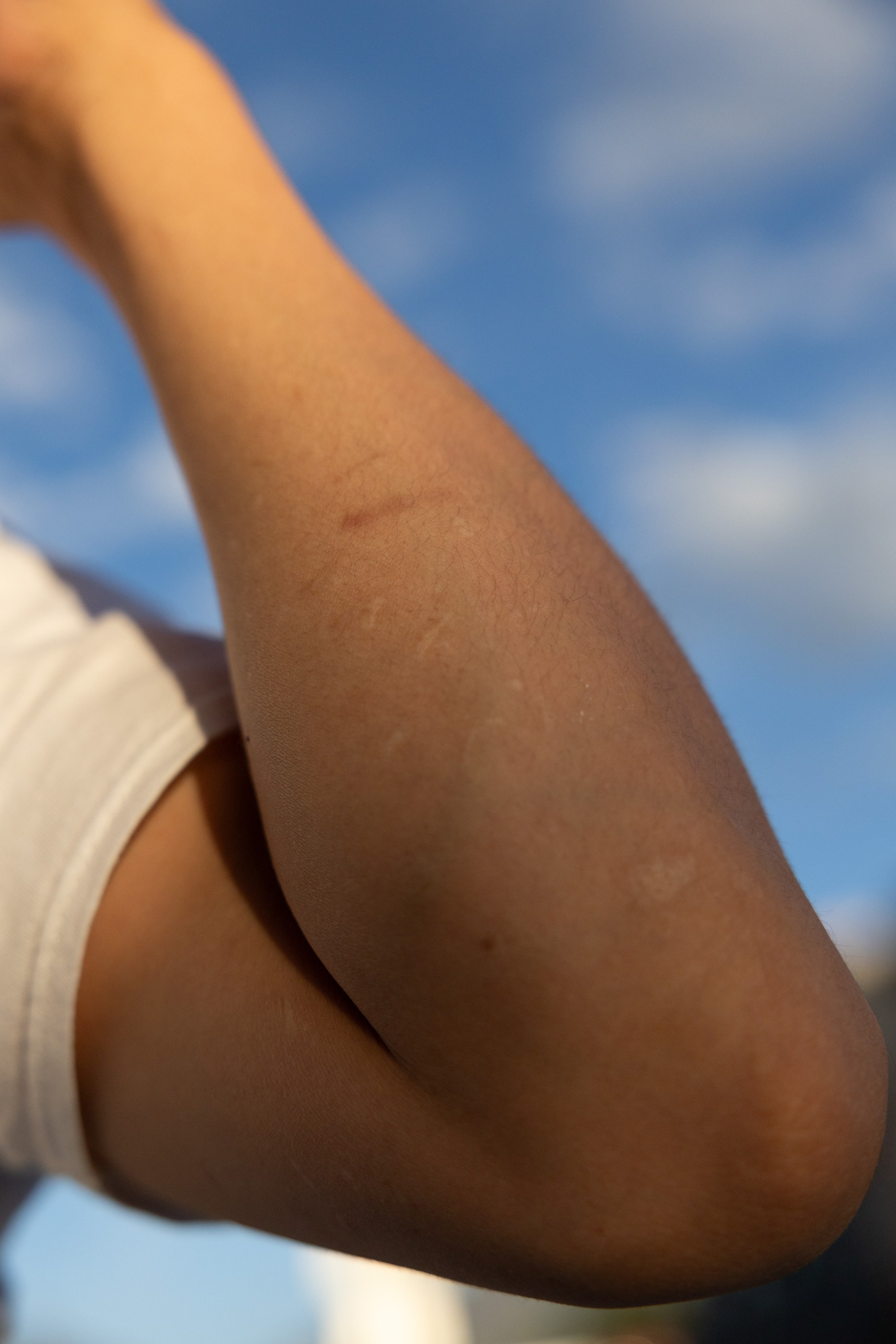 A close-up view of a person’s bent arm, showing healed scars on